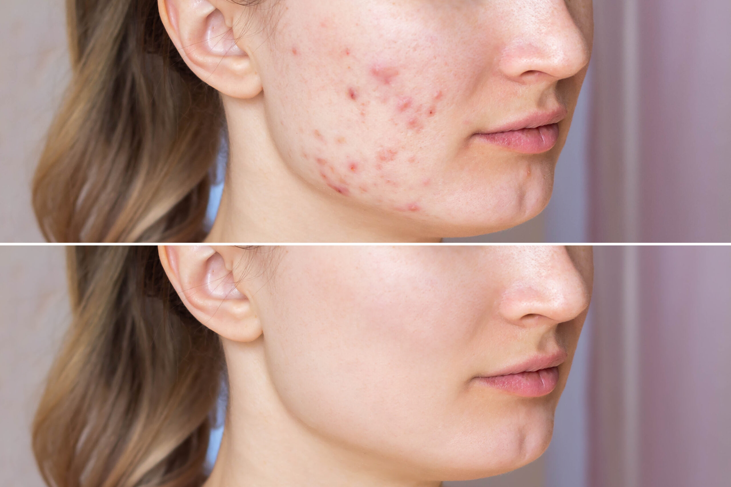 Cropped,Shot,Of,A,Young,Woman's,Face,Before,And,After