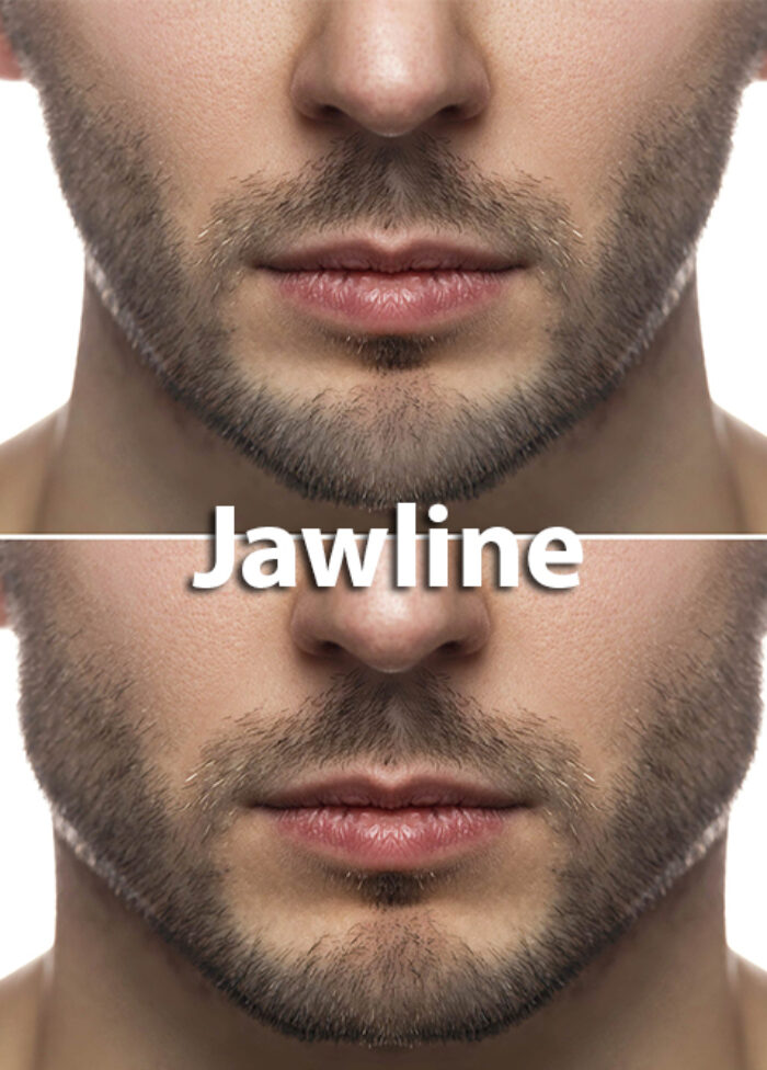 Hair,Transplant,-,Fue,-,Dhi,-,Sappphire,Techniques